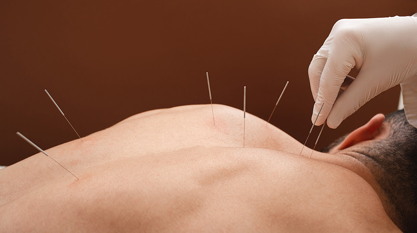 benefits of acupuncture