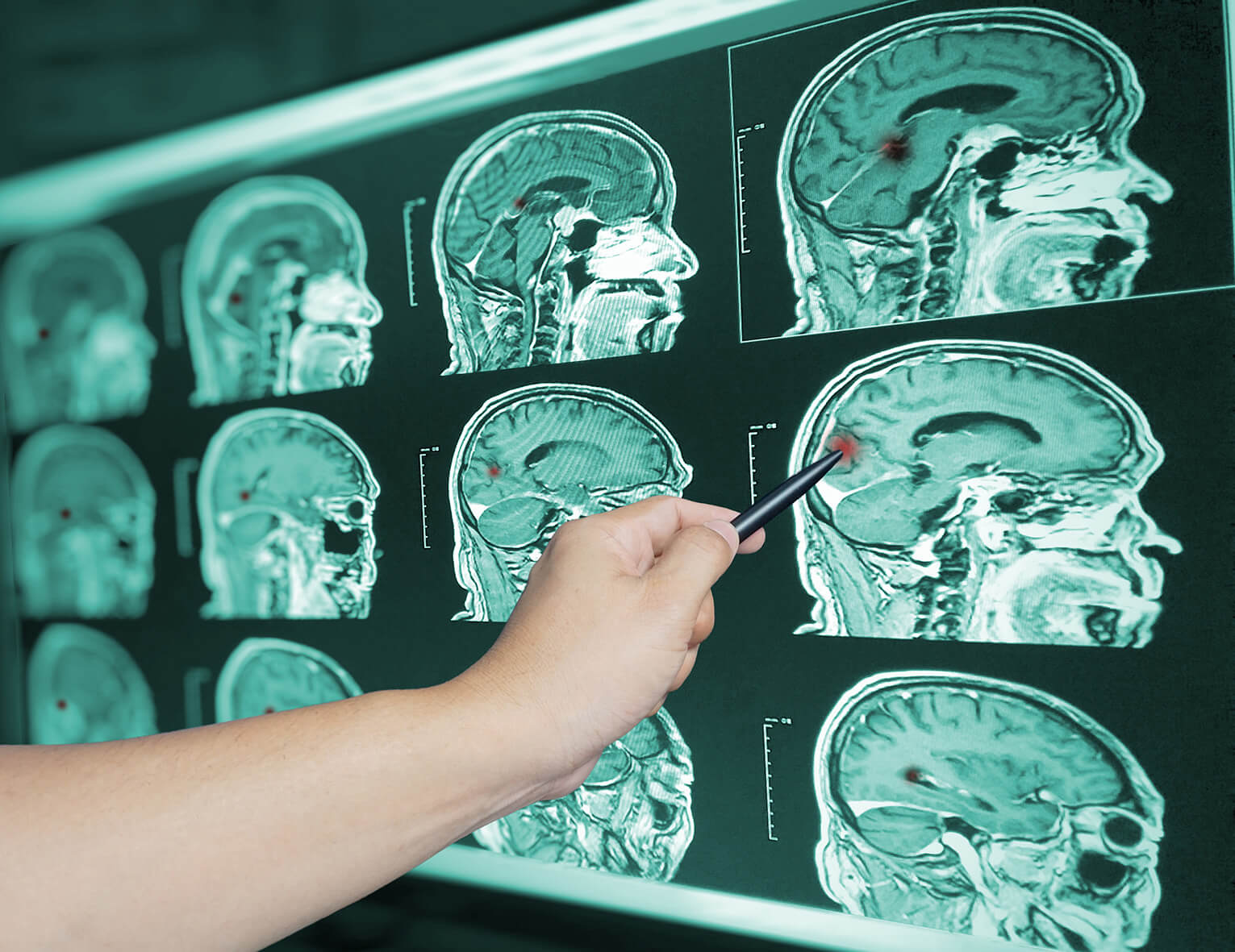 chiropractors help with TBI